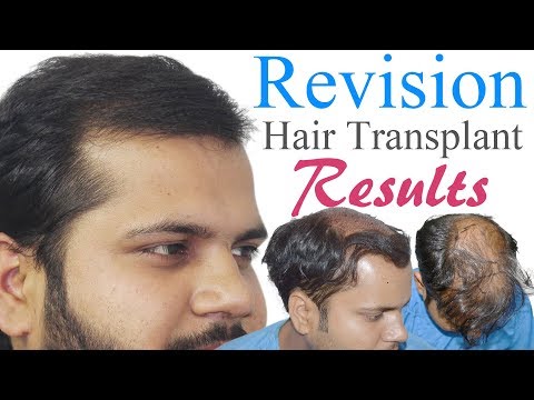 Hair Restoration Photo Gallery | Medispa Clinic India