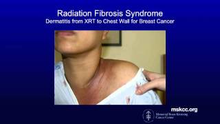 Radiation Fibrosis Syndrome | Memorial Sloan Kettering