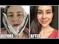 I Got Plastic Surgery in Korea || Before & After || Double Jaw Surgery Experience Part 3