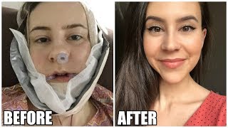 I Got Plastic Surgery in Korea || Before & After || Double Jaw Surgery Experience Part 3