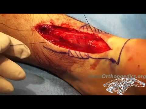 Offen chirurgische Reparatur von einem Achillessehnenriss