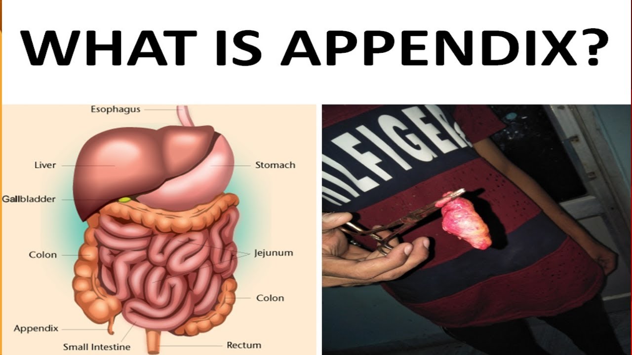 What is appendix?Symptomswhy do we need to remove