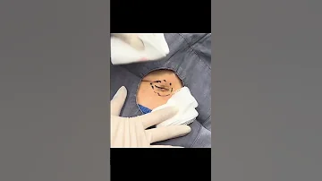 Two Cysts One Pop 