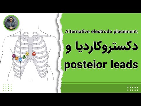 دوره آموزش نوار قلب قسمت پنجم محل هاي جايگزين الكترود ها 1 اختلالات قلبي
