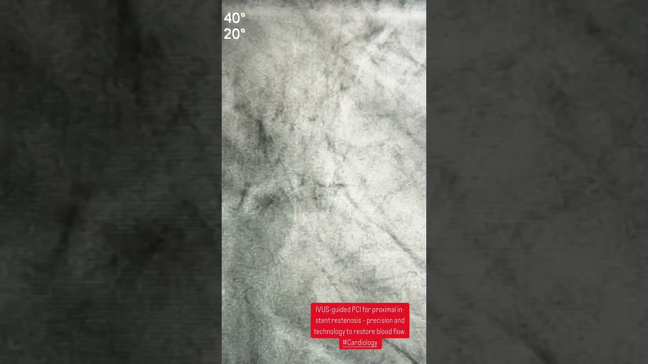 "IVUS-guided PCI for proximal in-stent restenosis – precision and technology to restore blood flow.