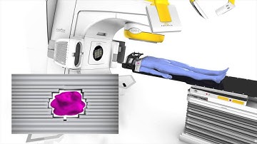 What is stereotactic radiosurgery? Interview Dr Andrew See