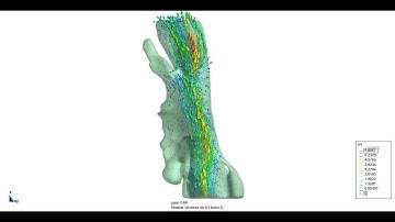 Pharynx Numerical Simulation: Velocity Vector Field