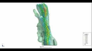 Pharynx Numerical Simulation: Velocity Vector Field