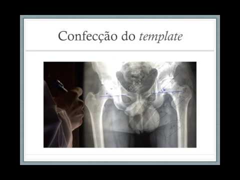 Vídeo: Haste Modular Na Artroplastia Total Do Quadril Para Pacientes Com Deformidade No Trocânter Valgo: Técnica Cirúrgica E Série De Casos