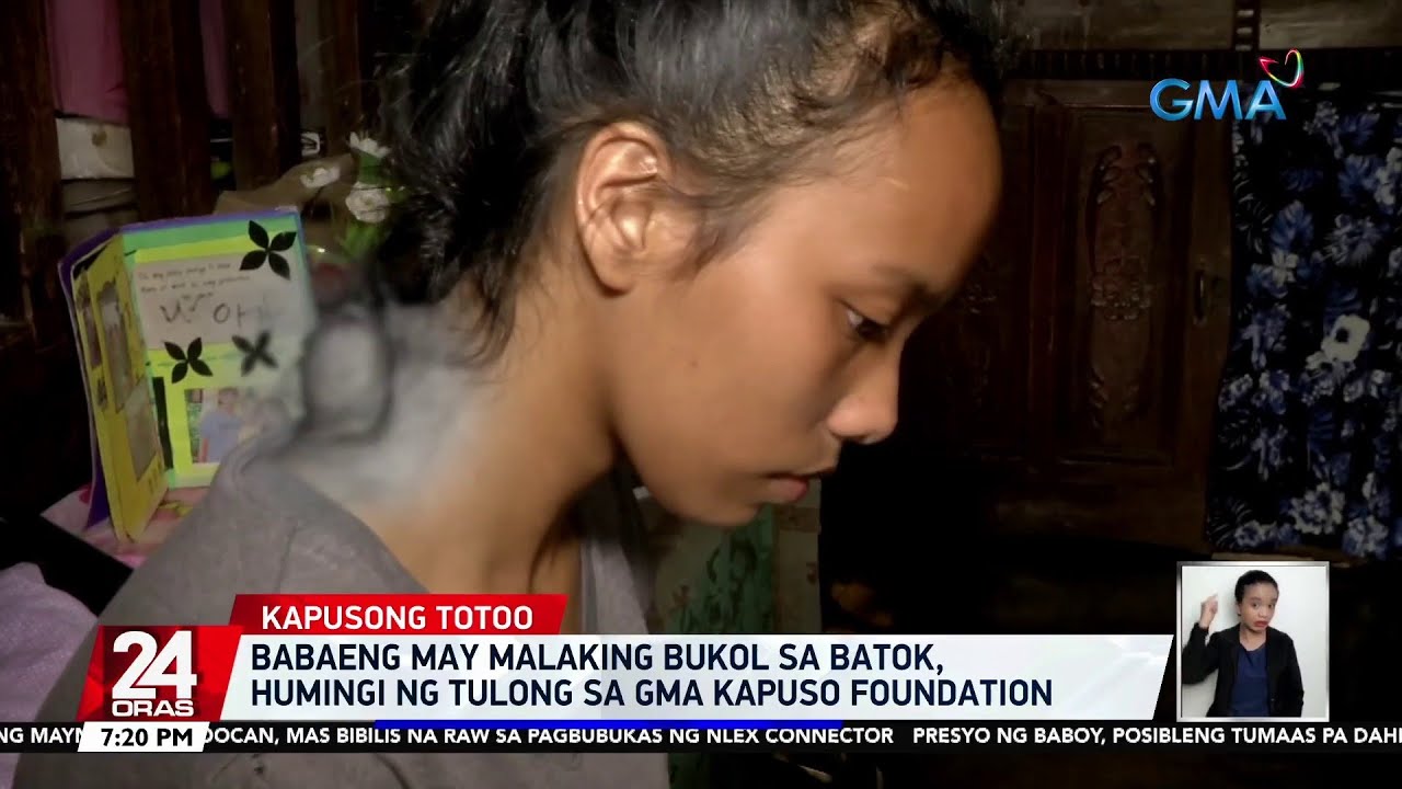 Babaeng May Malaking Bukol Sa Batok Humingi Ng Tulong Sa GMA Kapuso babaeng-may-malaking-bukol-sa-batok-humingi-ng-tulong-sa-gma-kapuso