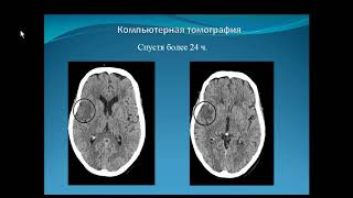 Алдатов Р.Х.«Нейровизуализация острого ишемического инсульта»