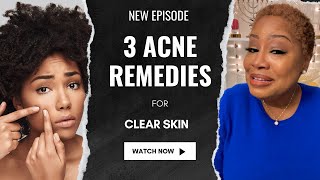 3 Acne Remedies for Pimples