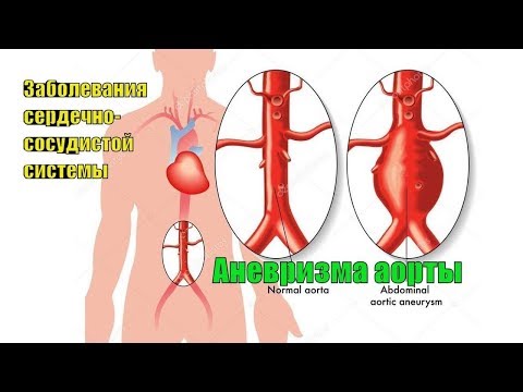 Опасные для силовых видов спорта заболевания сердечно-сосудистой системы. Аневризма аорты