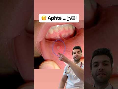 القلاع الفموي طب دكتور ليث سوريا دمشق المانيا العراق   اكسبلور