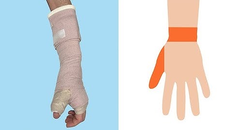 Building a thumb spica splint