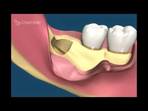 Удаление зубов  Все виды удаления зубов моляры премоляры резцы анастезии  Хирургическая стоматология