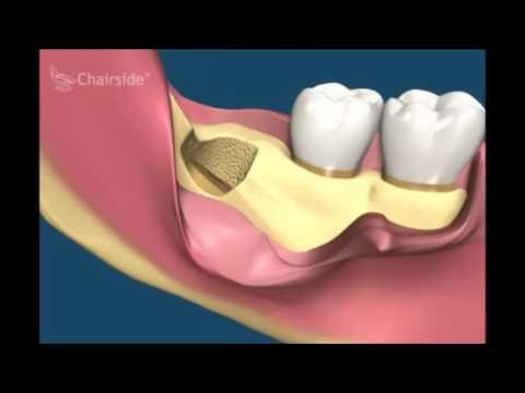 Видео: Больно ли удалять премоляры?