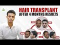 Hair transplant after 4 months results  care well medical centre