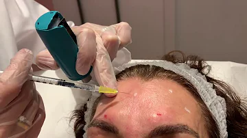 ¿Cuántas sesiones de Botox son necesarias para la frente?