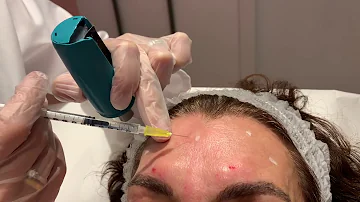 ¿Cuántas unidades de Botox son buenas para la frente?