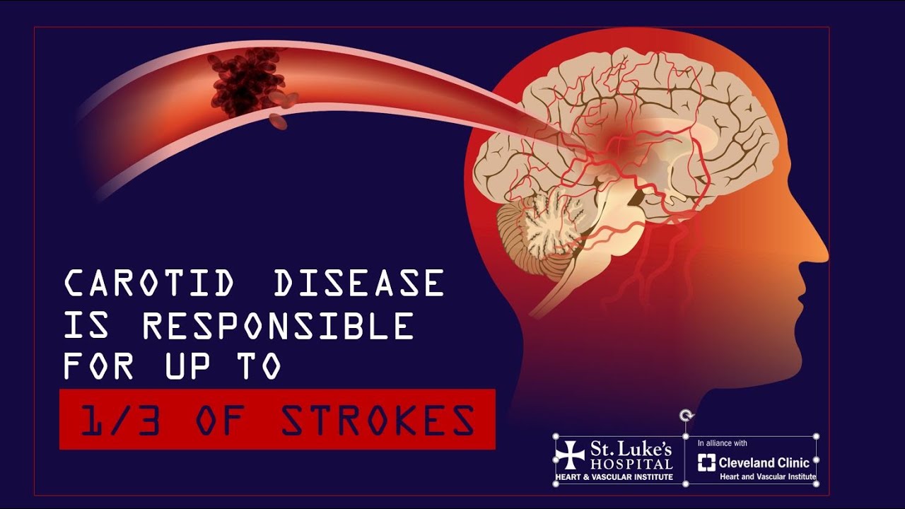 Carotid Artery Disease And Stroke Know The Signs And Symptoms YouTube Carotid Artery Disease And Stroke Know The Signs And Symptoms YouTube