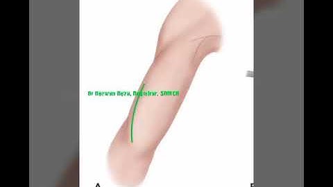 Henry antero lateral approach to Humerus(ref: campbell)