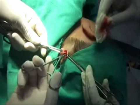 Removal of Scalp Dermoid Cyst under local anaethesia cystic teratoma