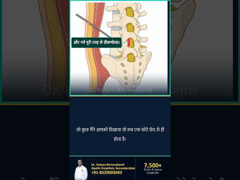 8mm keyhole के चार फायदे — Best Endoscopic Spine Surgeon, Hyderabad