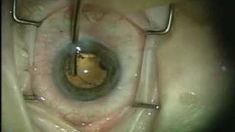 Insertion of the Capsular Tension Ring in Pseudoexfoliation