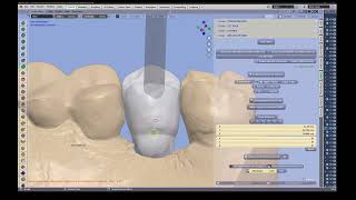 Crown Module - Making an Implant Crown