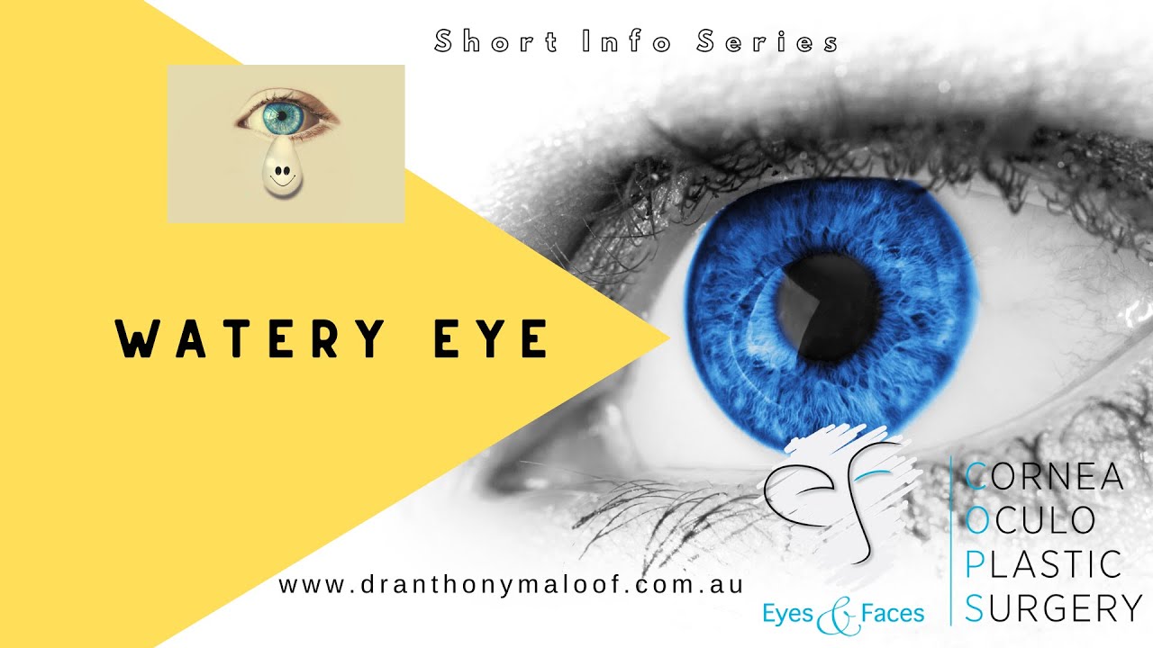 Watery eye - Dr Anthony Maloof - Sydney Australia