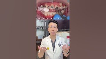 Khởi đầu của quá trình niềng răng #nhakhoaquocteachau #niengrang #dentist