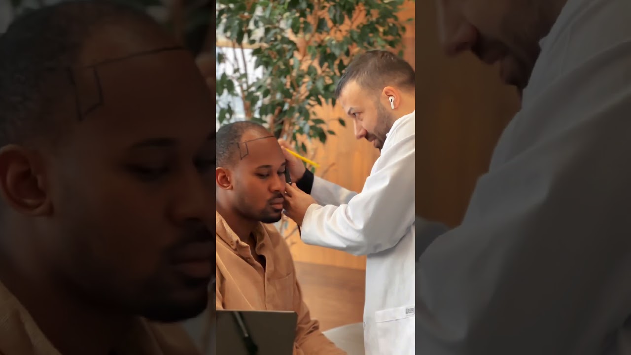 Afro Hair Transplantation