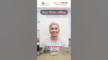 Hành trình LỘT XÁC nhờ niềng răng của Vũ Phương