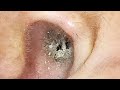 【耳掃除】#96 耳かき 〜粘着綿棒の出番!!〜 earwax