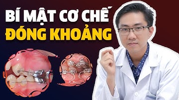 Nhổ Răng Khi Niềng | Bí Mật Cơ Chế Đóng Khoảng | Kiến Thức Nha Khoa
