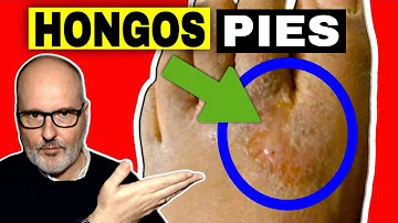 ¿Qué ocurre si no se tratan los hongos de los dedos de los pies?