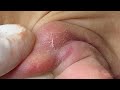 Ear Cysts | Mụn, U Bã Đậu Ở Tai - SacDepSpa#314