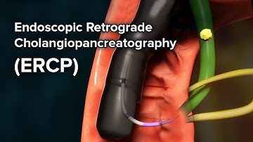 Endoscopic Retrograde Cholangiopancreatography (ERCP): ERCP Test Procedure, Surgery & Complications
