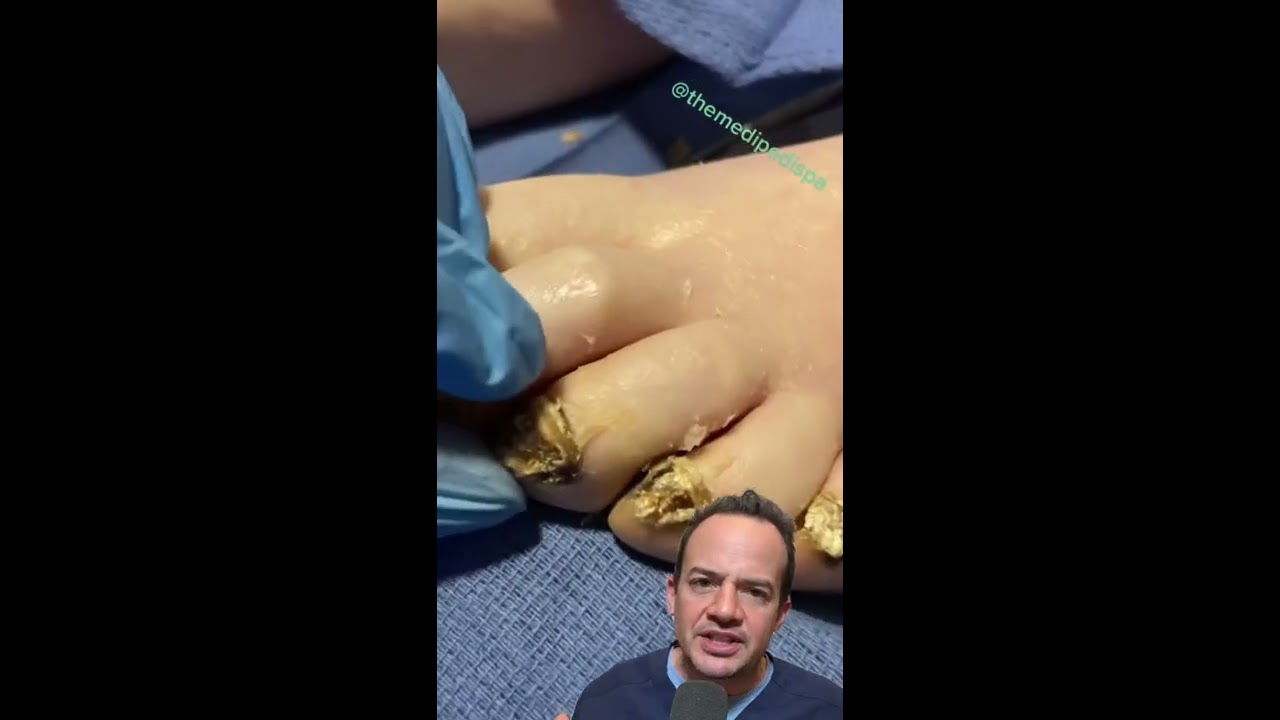 DOCTOR REACTS ARE THESE TOENAILS DEAD Shorts