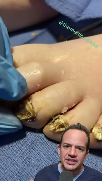 DOCTOR REACTS: ARE THESE TOENAILS DEAD? 😱 #shorts