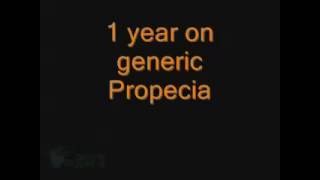 finasterid generika preis