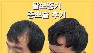 단 시간에 남자 중기탈모 9,000모 쿠션 증모술, 애즈펌은 덤으로~