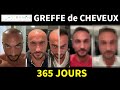 Jour 1 au jour 365 une photo par jour aprs une greffe de cheveux timelapse