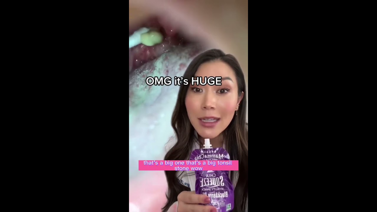 HUMONGOUS Tonsil Stone Tonsilstones Tonsils Dentist