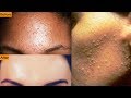Get Rid Of Tiny Bumps On Face || Simple Home Remedy || Mamtha Nair