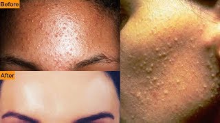 Get Rid Of Tiny Bumps On Face || Simple Home Remedy || Mamtha Nair