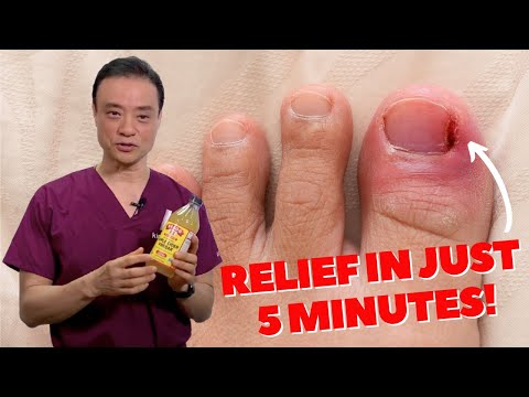 6 HOME REMEDIES To Treat A PAINFUL Ingrown Nail | Dr. Kim