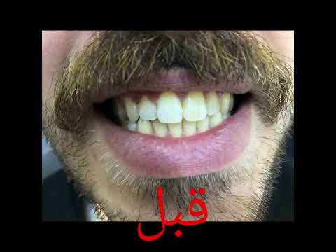تبييض الاسنان بالليزر