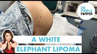 A White Elephant Lipoma